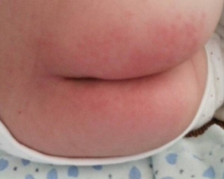 寶寶紙尿褲過(guò)敏怎么辦