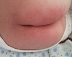 紙尿褲過(guò)敏的癥狀